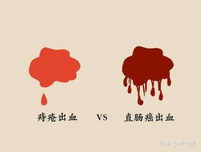 痔疮出血颜色解析：鲜红色代表什么？