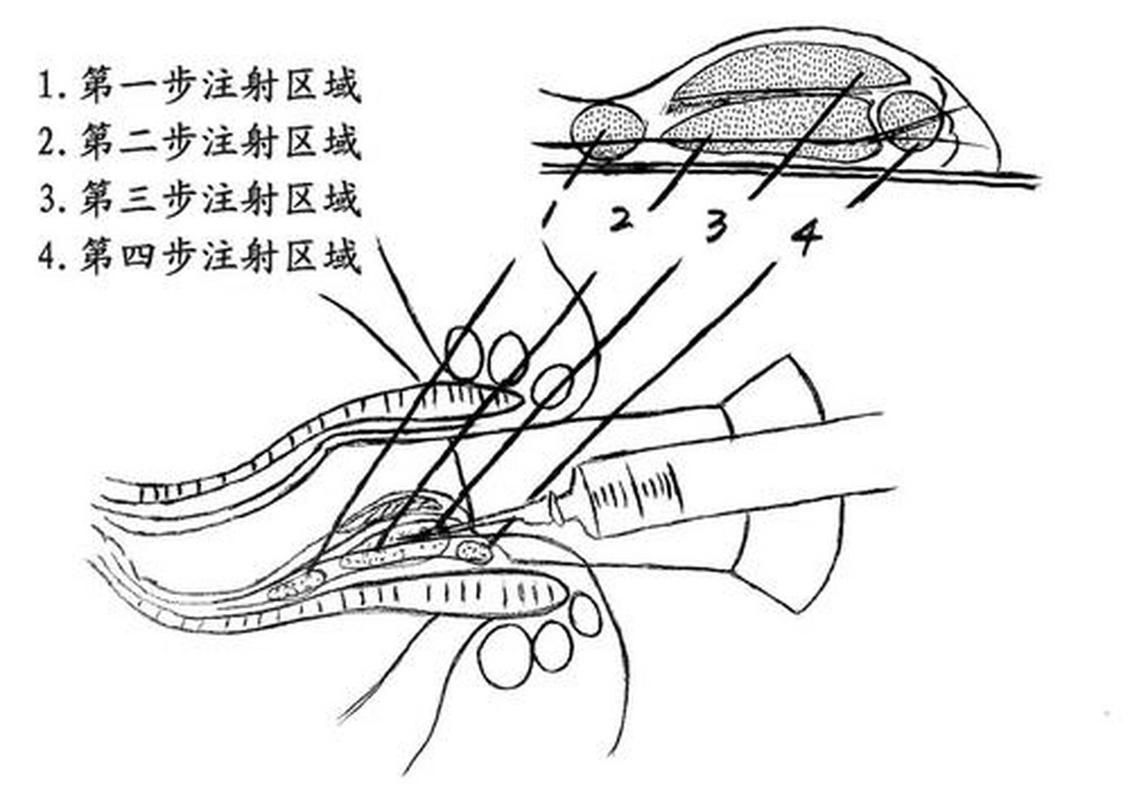 痔疮注射治疗