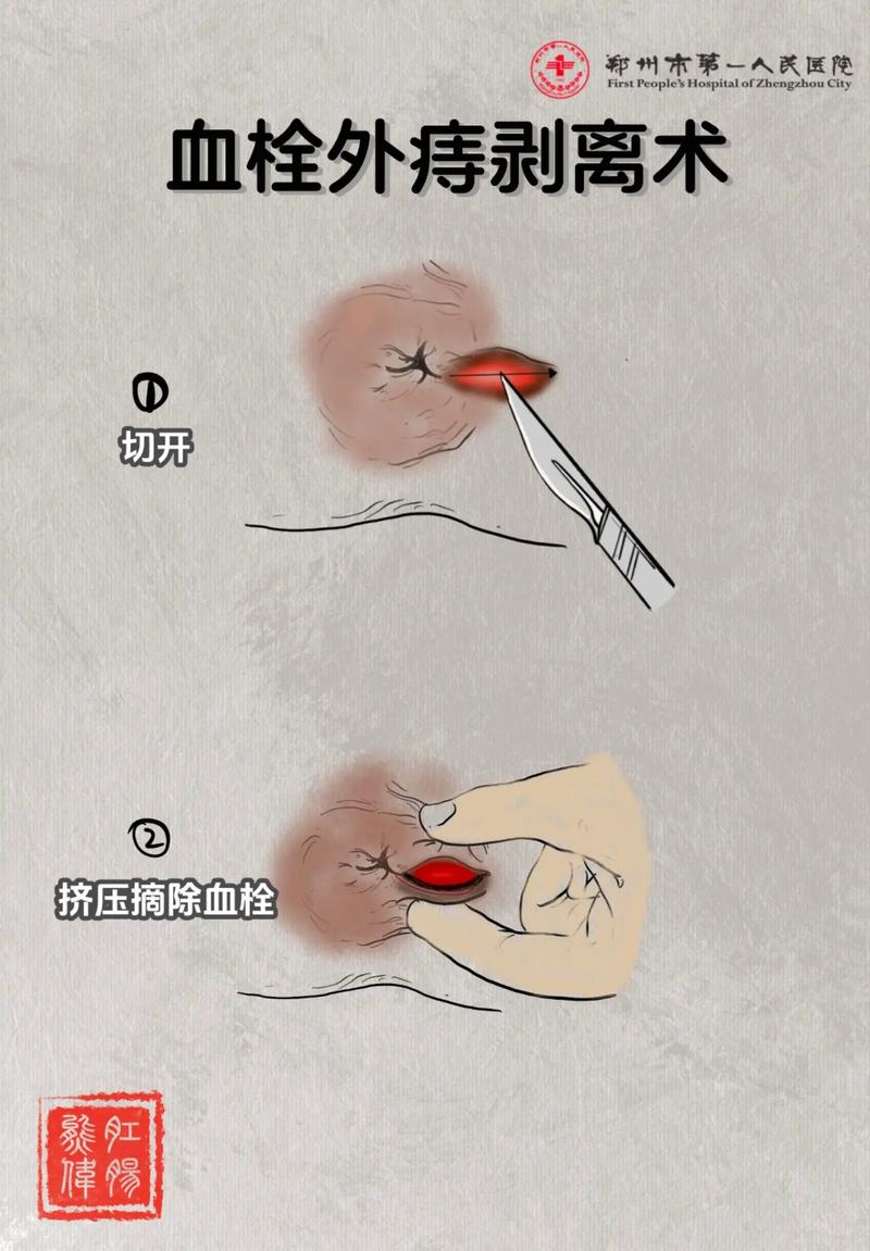 痔疮动脉栓塞术