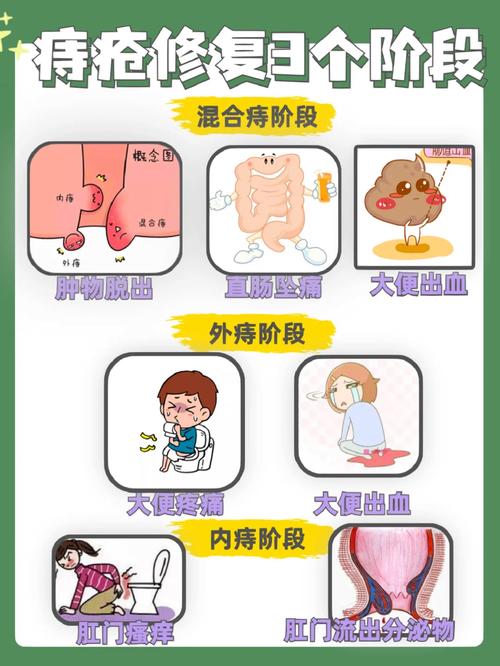 痔疮恢复过程：多久才能彻底无痛？