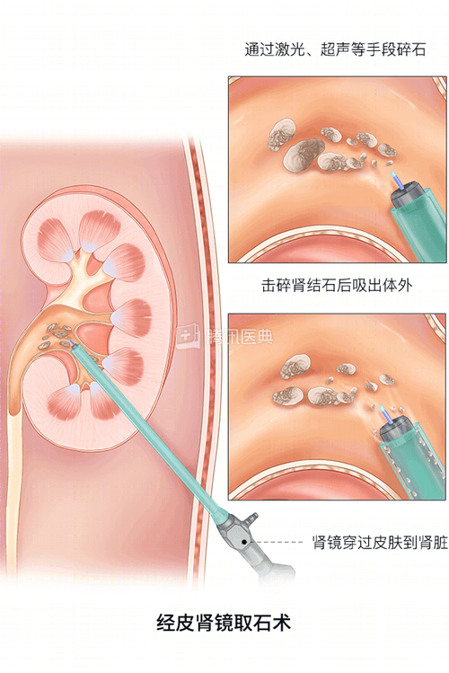 激光碎石