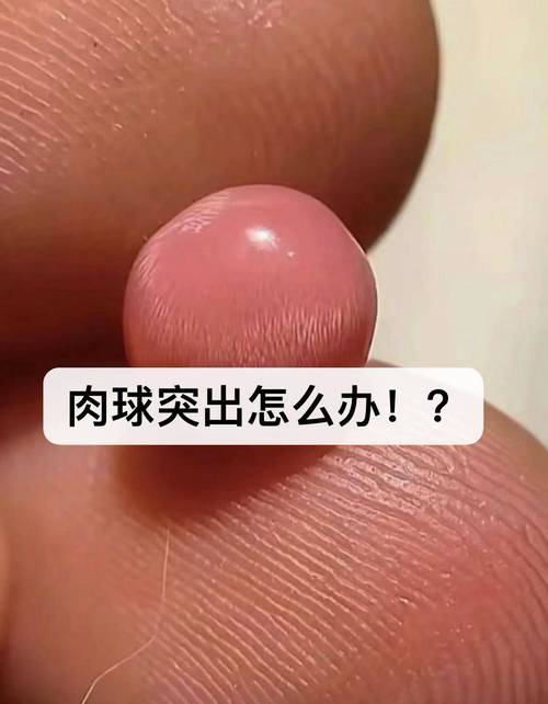 木豆叶：天然疗法竟然能治好痔疮？