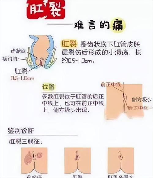 肛裂症状