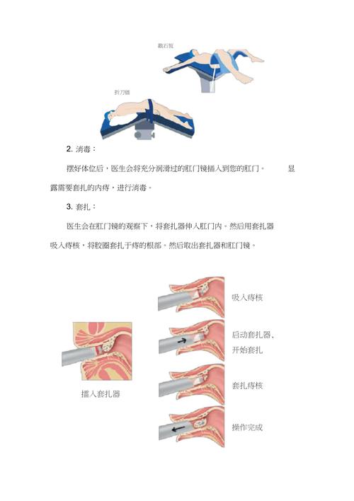 冲击波治疗痔疮