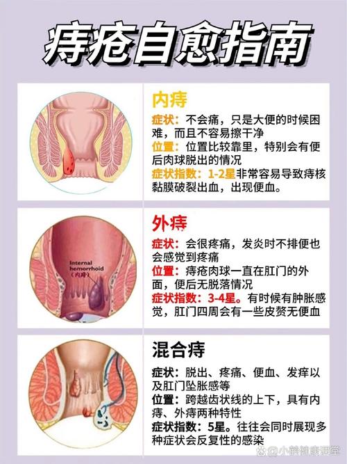 忻州痔疮治疗方法