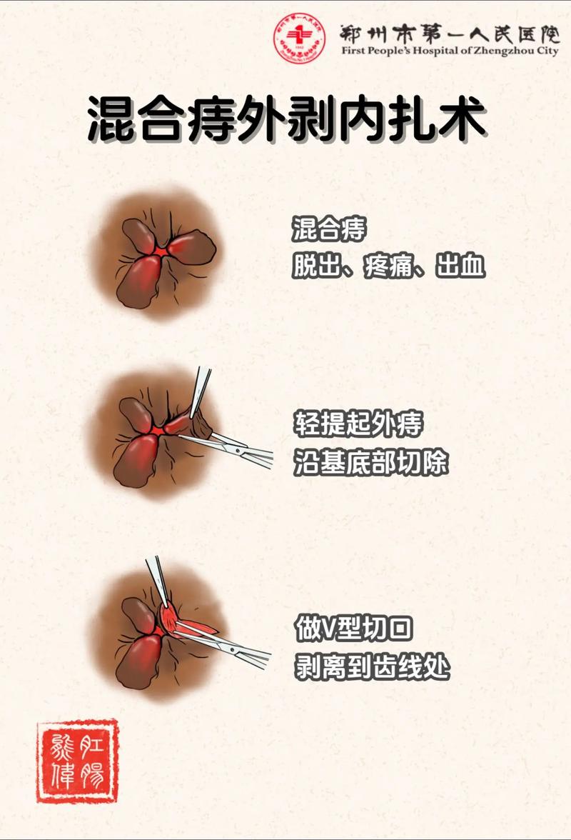 痔疮手术判断