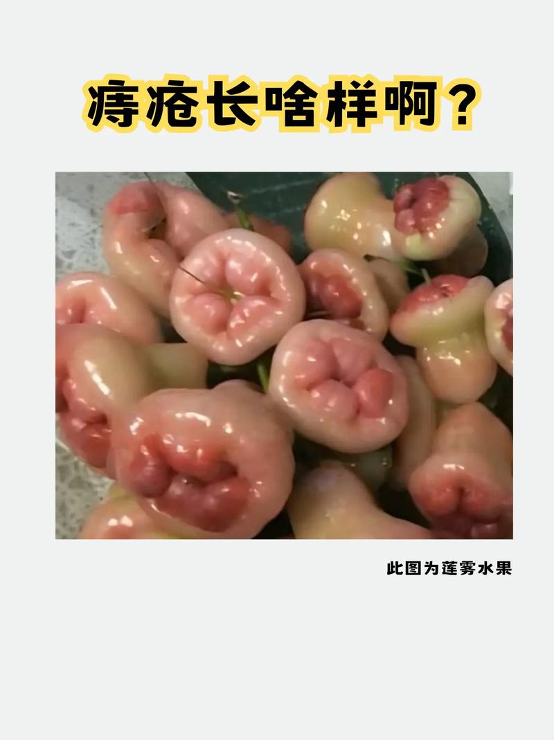 天津哪里有无痛痔疮治疗？