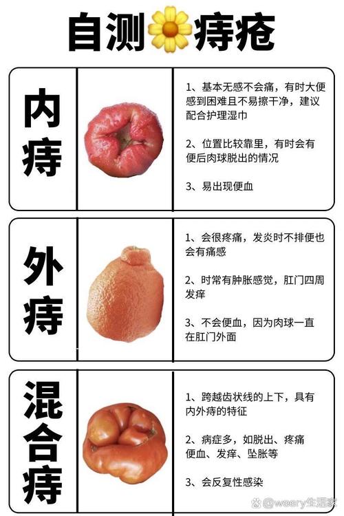 不严重痔疮