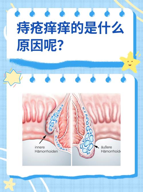 屁股外长痔疮是否会造成瘙痒感？