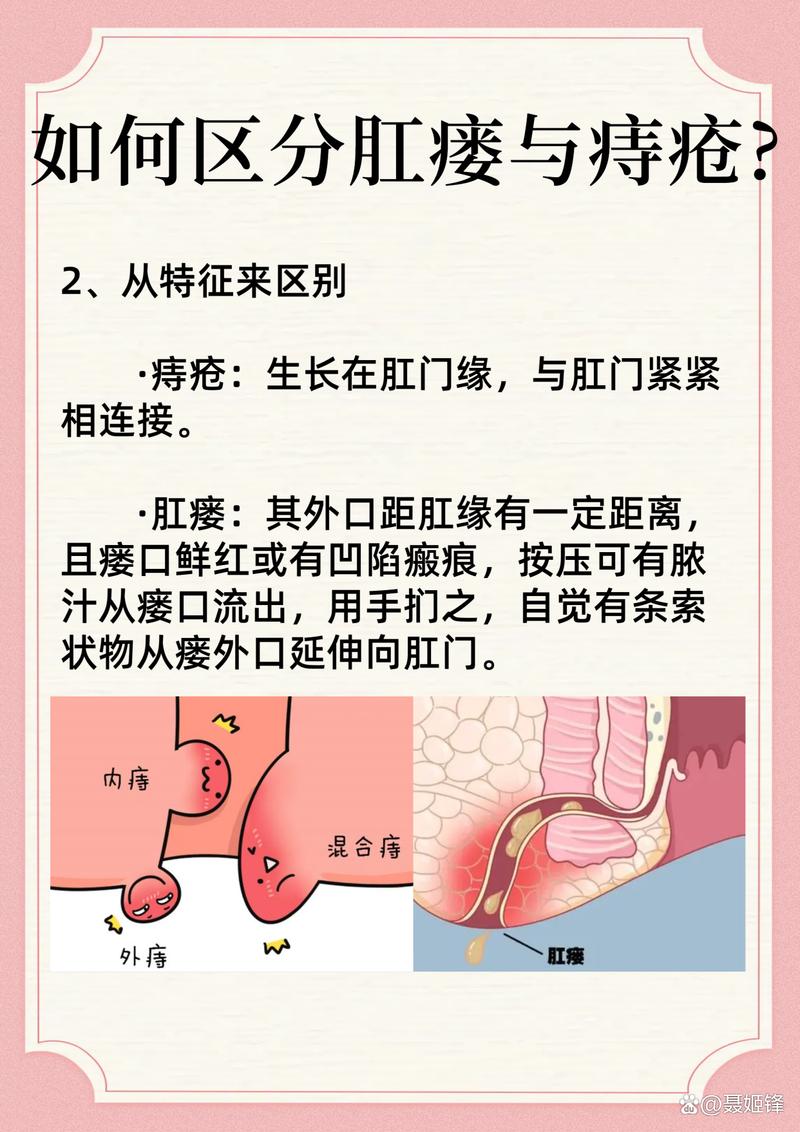 肛瘘与痔疮的区别是什么？