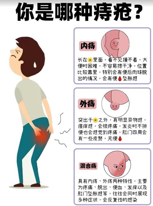 老年人健康：所有老人都易患痔疮吗？