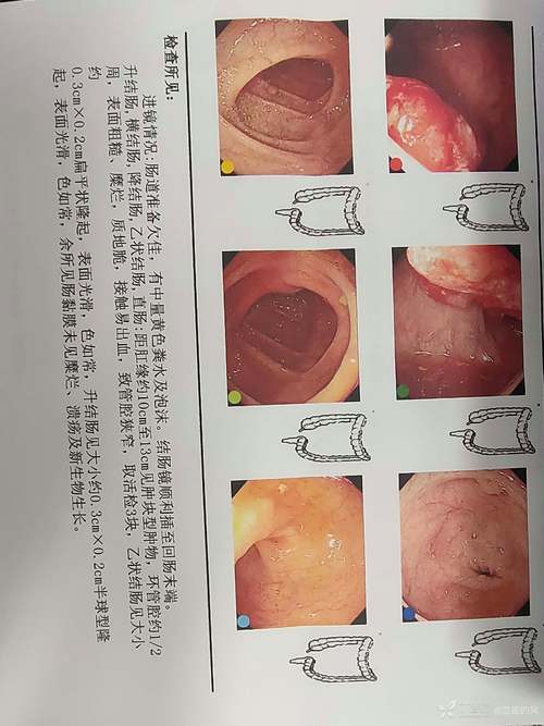 直肠肿瘤