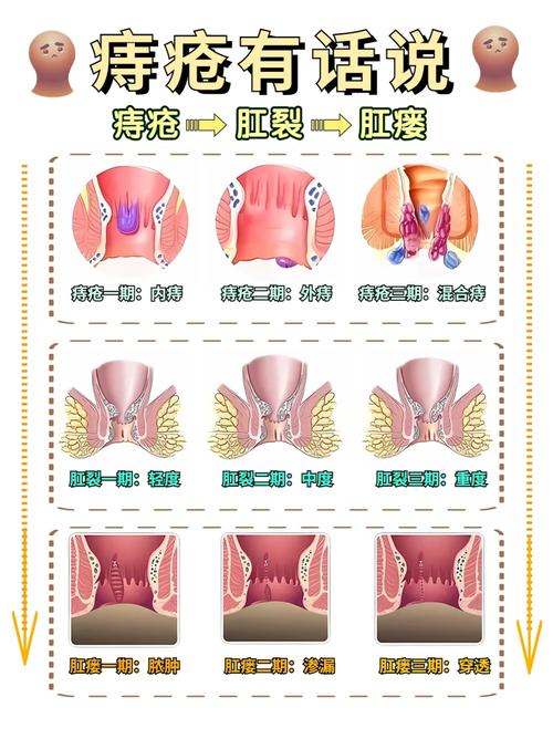 外痔疮肉瘤