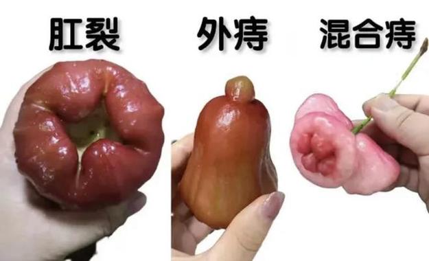 蜂蜜泡蚂蝗真的能治愈痔疮吗？