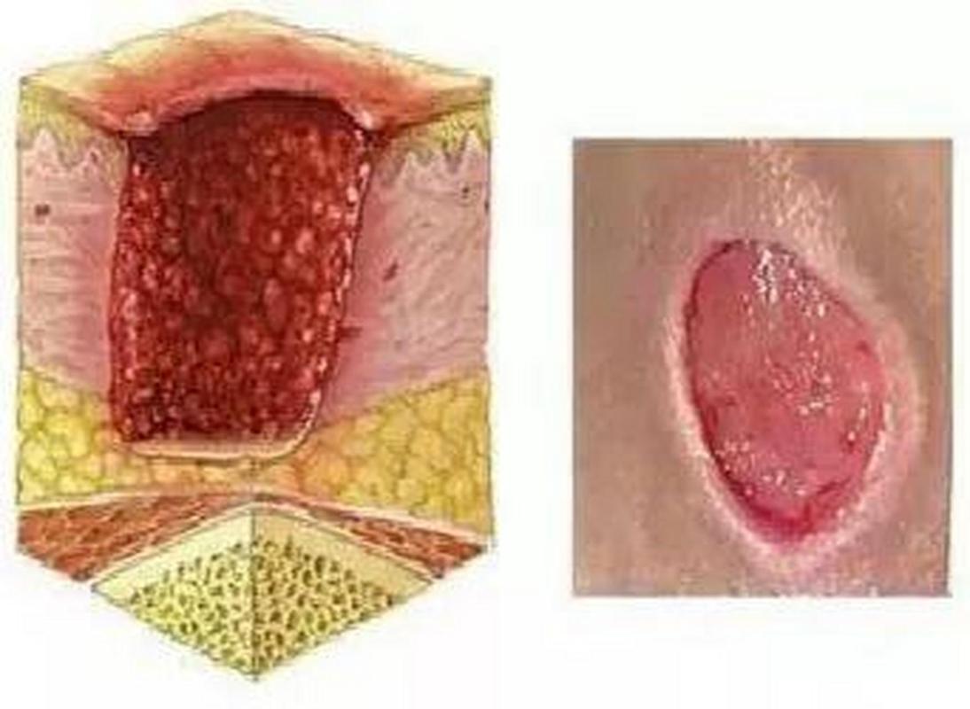 肉芽组织增生