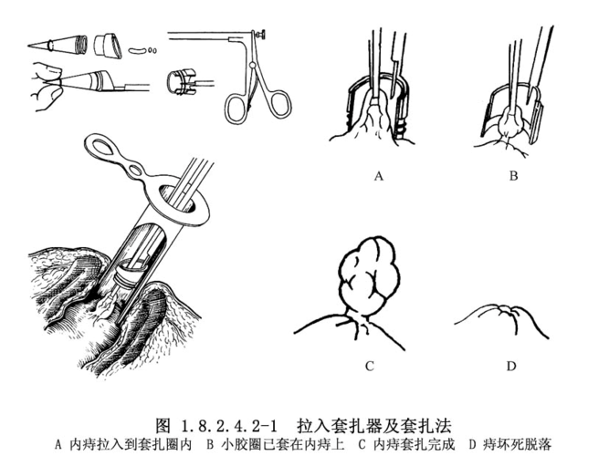 胶圈套扎术