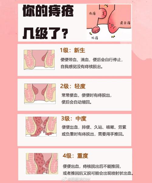 痔疮定义