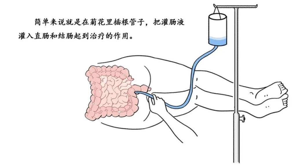 灌肠方法