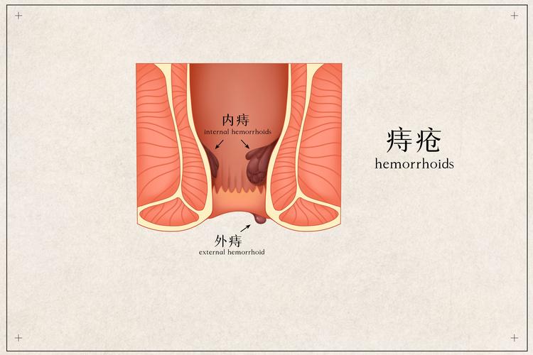 痔疮图到底是什么？