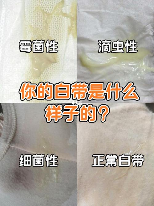 女性白带异常