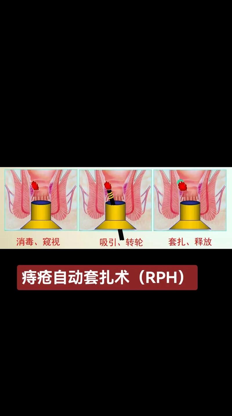 痔疮手术治疗方法