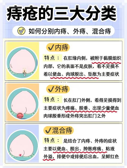 十人九痔疮怎么办？有效治疗方法全解析