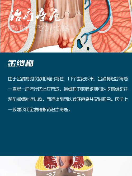 哥哥患有痔疮？这里有几种有效治疗方法