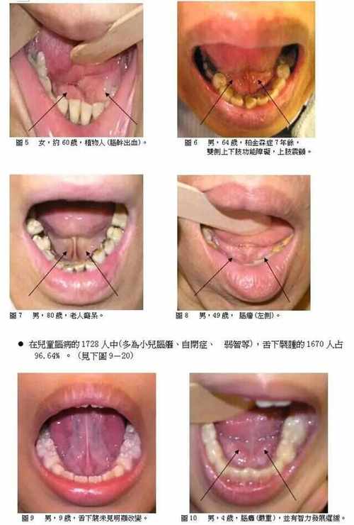 济宁挑舌筋疗法