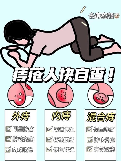 痔疮不疼