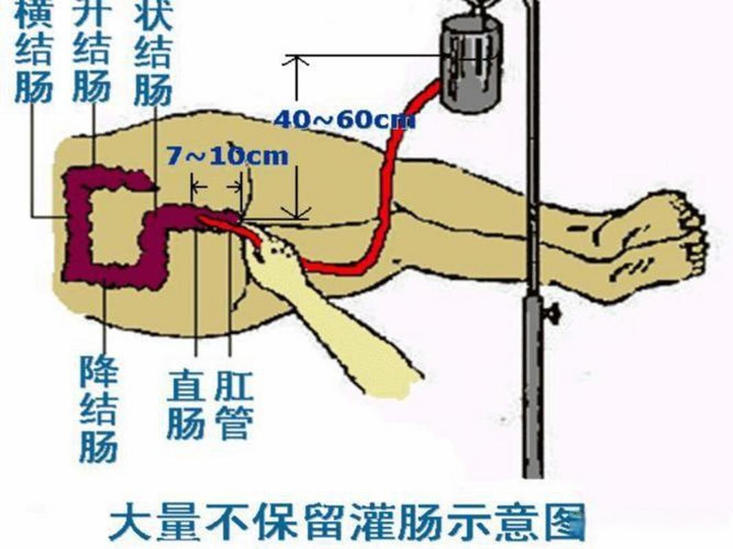 灌肠法